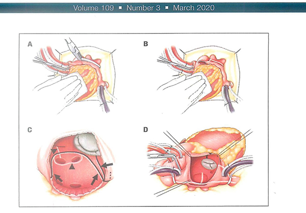 THE ANNALS of THORACIC SURGERY