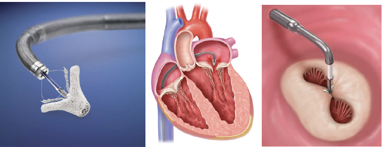 経皮的僧帽弁形成術の実際