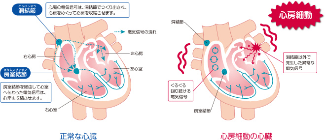 心房細動とは