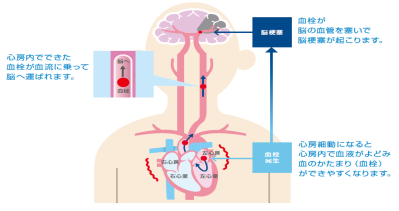 心房細動と脳梗塞の関係