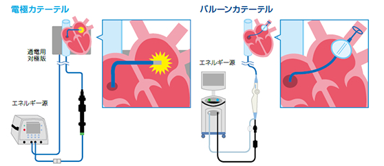 カテーテルアブレーションの種類