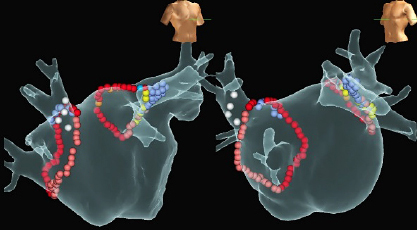 最新の３D-Mapping Systemを使った心房細動焼灼術